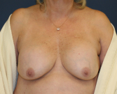 Feel Beautiful - Breast sagging and contracture - Before Photo